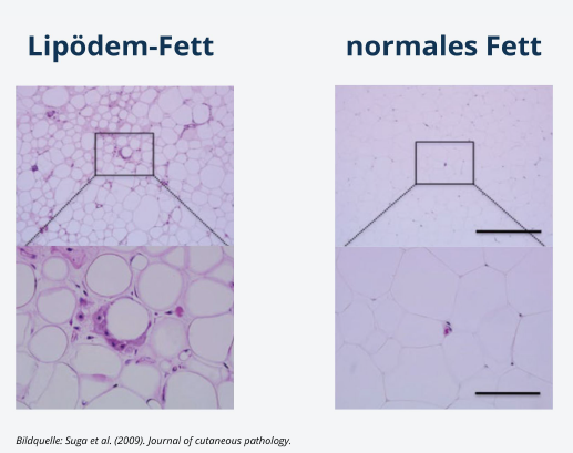 Entzündungszellen und ihre Rolle beim Lipödem